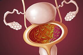 Bakterielle Zystitis bei einer Frau